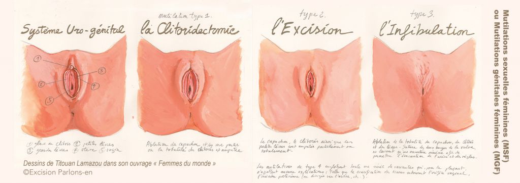 excision-dessin-titouan-lamazou