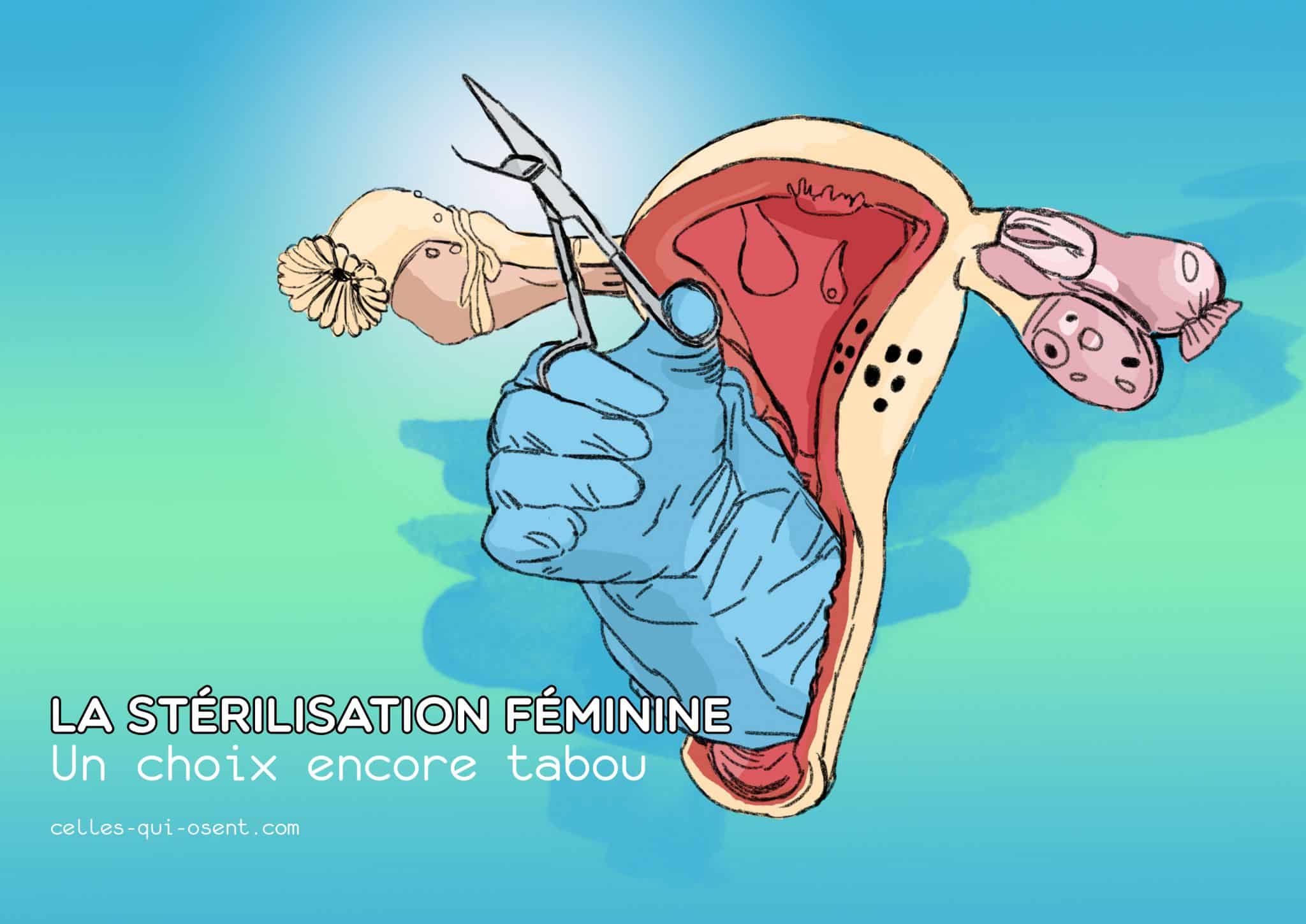 sterilisation-femme